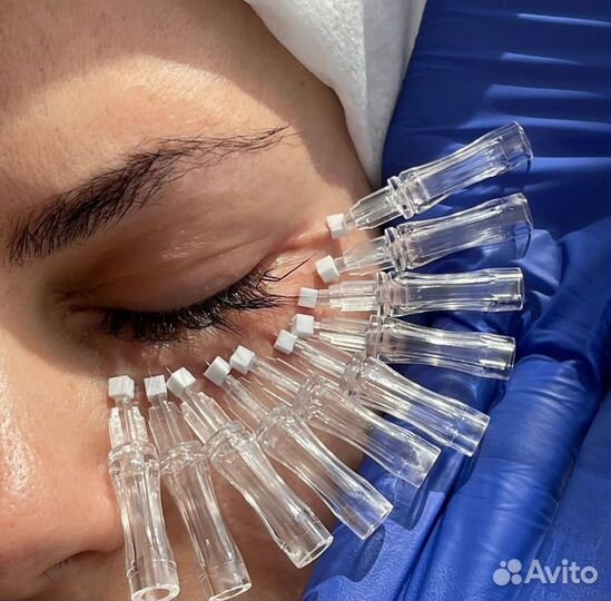 Мезонити (Тредлифтинг)