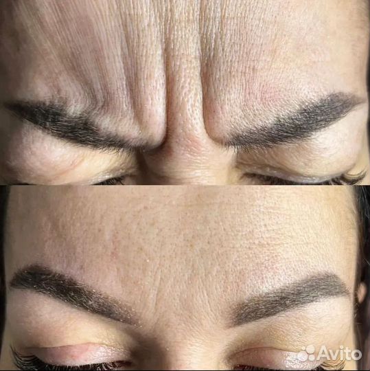 Ботулинотерапия / ботокс лба и межбровки