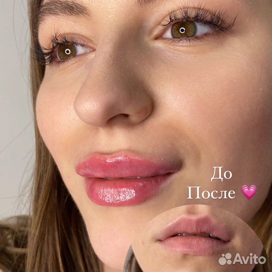 Увеличение губ,Косметолог,Биоревитализация
