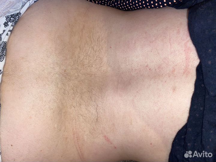 Депиляция воском