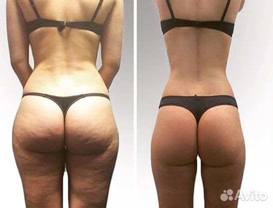 Антицеллюлитный массаж/коррекция фигуры