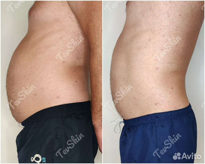 Липосоникс.Коррекция фигуры.Уменьшение объемов