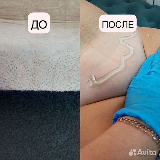 Лазерная эпиляция/шугаринг Энгельс