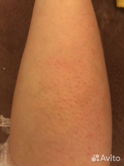 Электроэпиляция