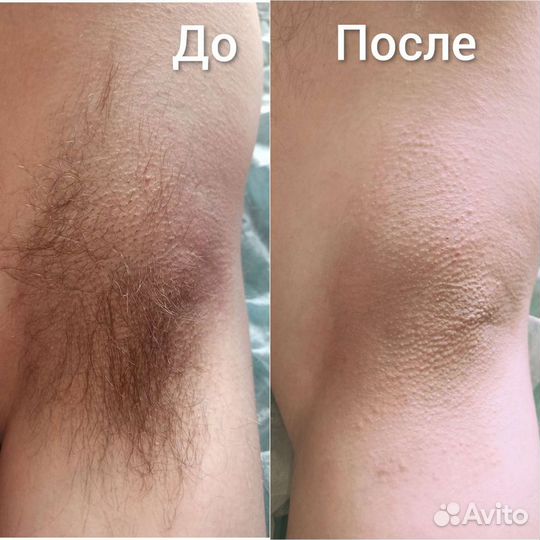 Депиляция