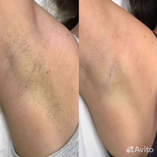 Продам прибыльный кабинет лазерной эпиляции