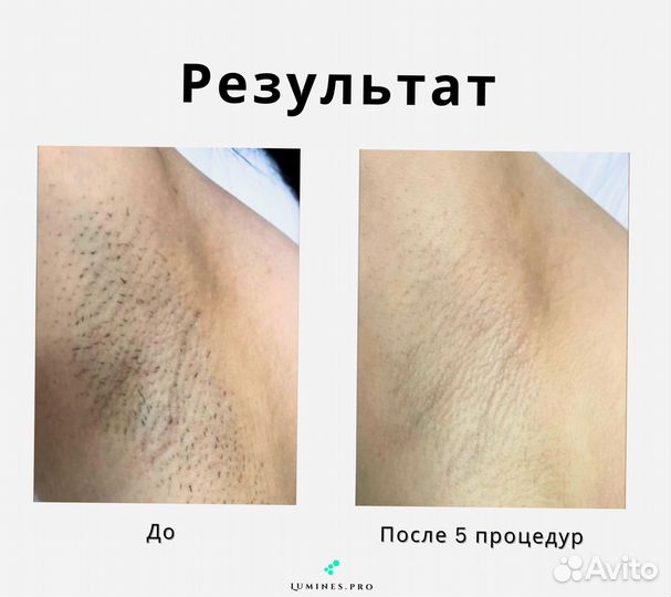 Диодный лазер для эпиляции люминес MaxOne 1200вт