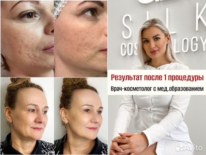 РФ - лифтинг / RF лифтинг лица и тела