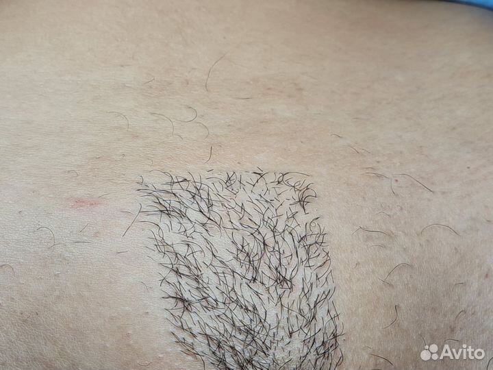 Электроэпиляция