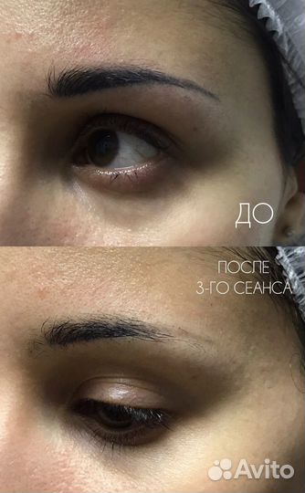 Модели на лазерное удаление татуажа бровей