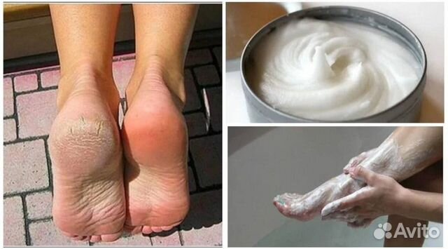 Актилайн - средство убирает грибок кожи и ногтей