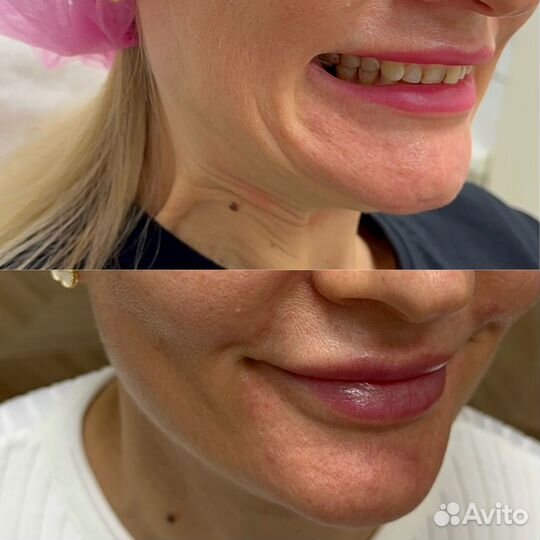 Лифтинг нефертити/ безопасная подтяжка овала лица