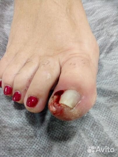 Лечебный педикюр