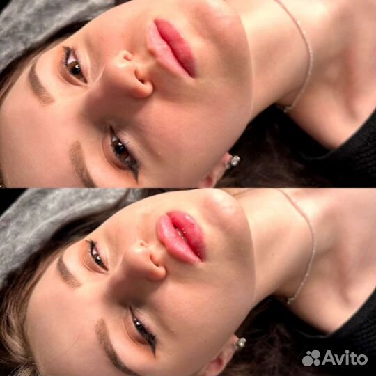 Увеличение губ