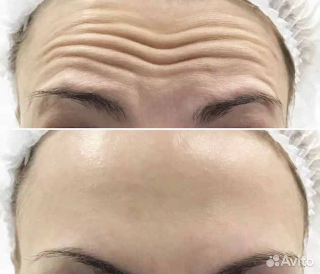 Ботокс для лица