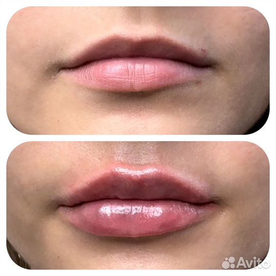 Иньекционная косметология и не только