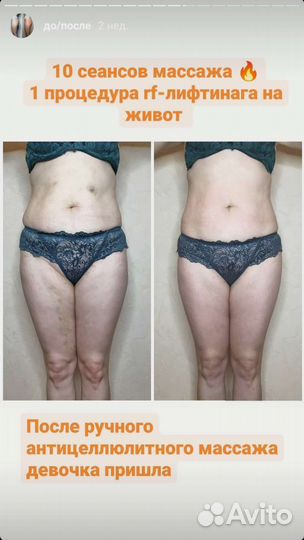 Антицеллюлитный массаж