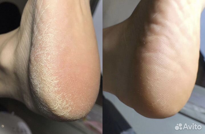 Педикюр с покрытием лаком