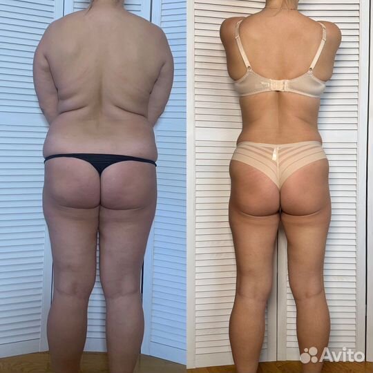 Антицеллюлитный массаж,Коррекция фигуры