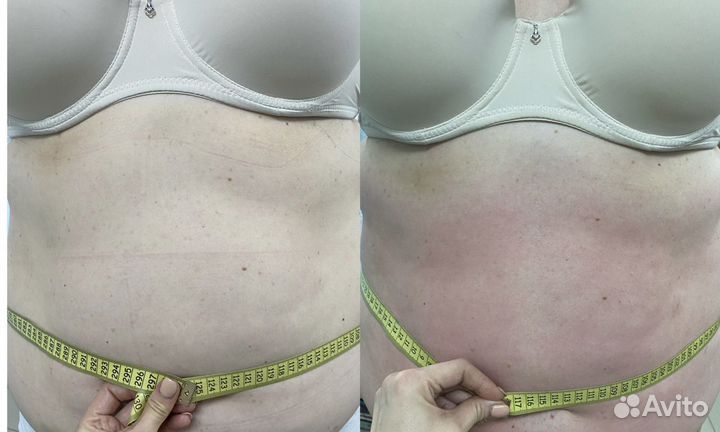 LPG массаж, жиротоп, вибро, антицеллюлитный массаж