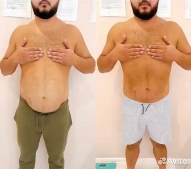 Курс Криолиполиза для мужчин