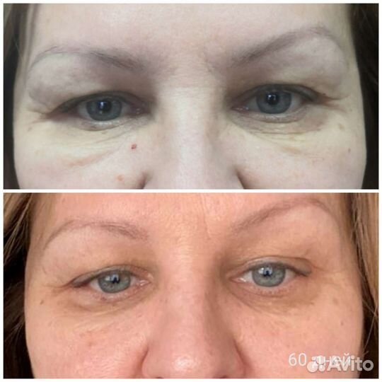 Блефаропластика без операции, нависшее веко, мешки