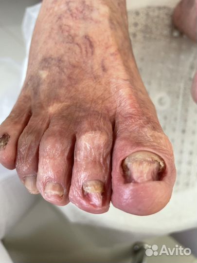 Педикюр Подология Бесплатно консультация