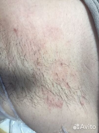 Электроэпиляция