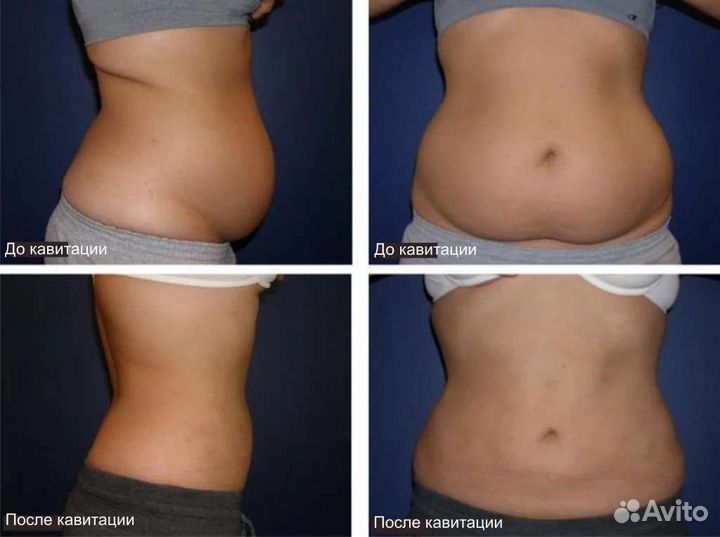 Мощный антицеллюлитный комплекс