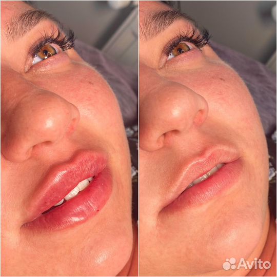 Увеличение губ