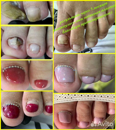 Медицинский педикюр