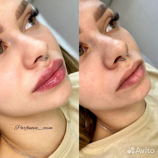 Увеличение губ