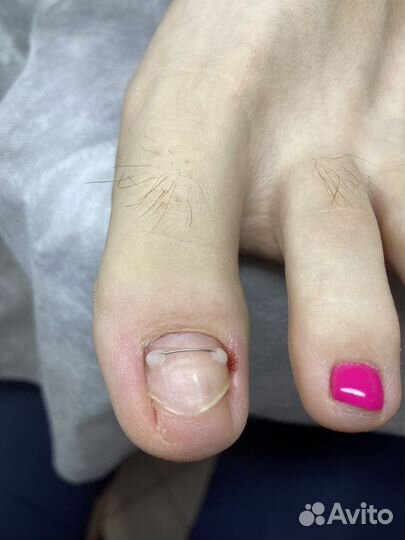 Удаление бородавок на стопах, подолог