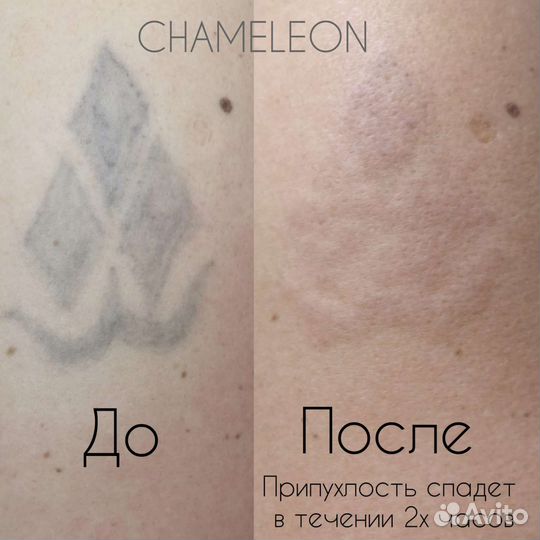Удаление татуировок