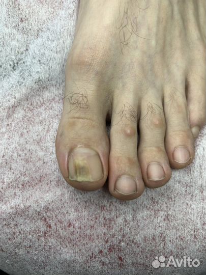 Лечебный педикюр