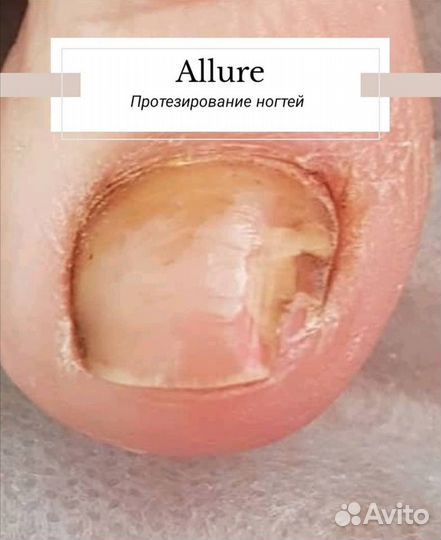 Медицинский педикюр