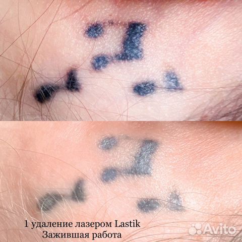 Удаление татуажа и тату лазером Lastik и ремувером объявление продам