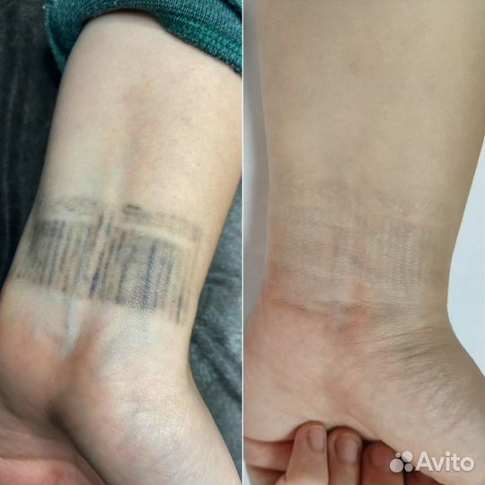 Удаление тату и татуажа