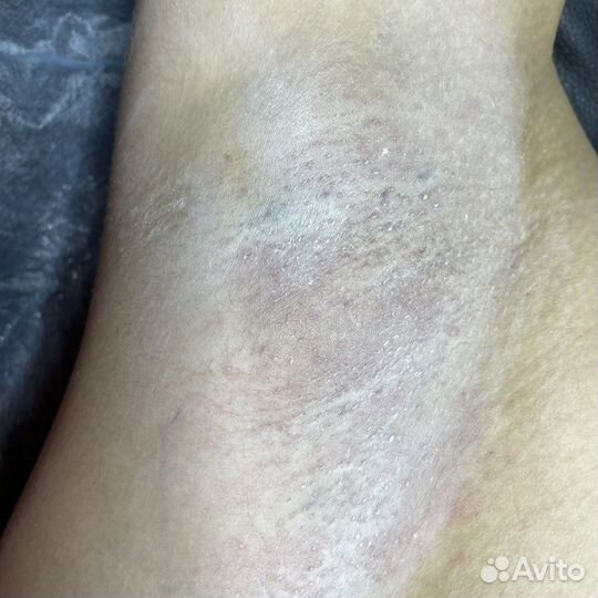 Электроэпиляция