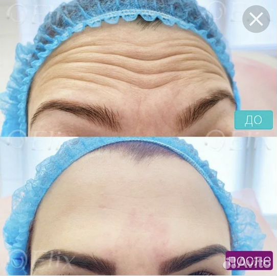 Ботокс для лица