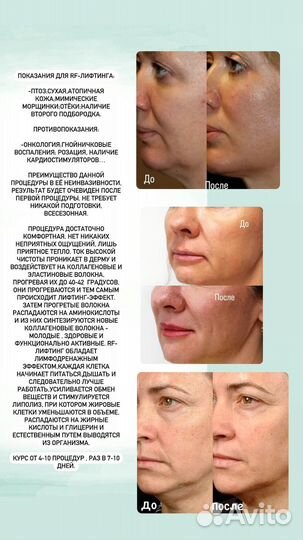 Косметолог, RF-лифтинг, УЗ чистка,мезотерапия