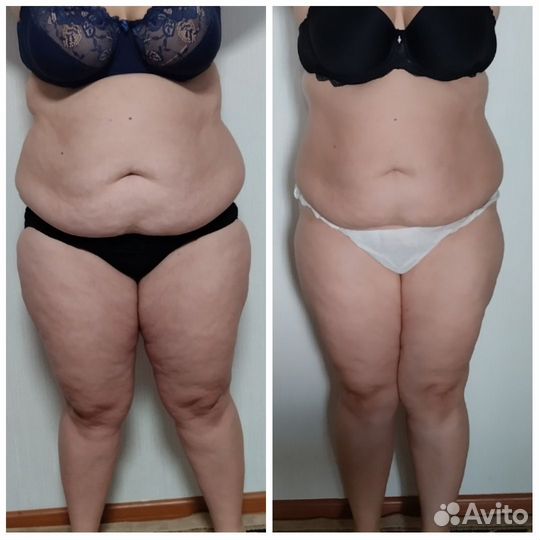 Вакуумный массаж, Кавитация, Rf лифтинг