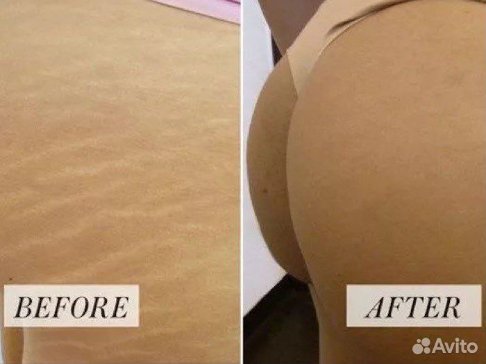 Татуаж шрамов