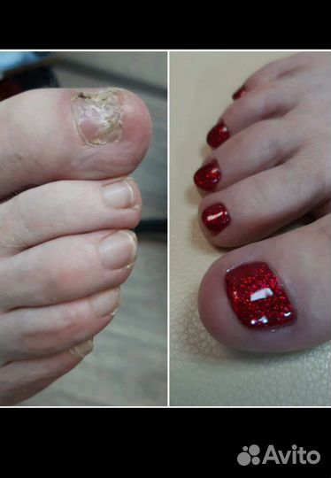 Медицинский педикюр.Подолог. Эстет педикюр