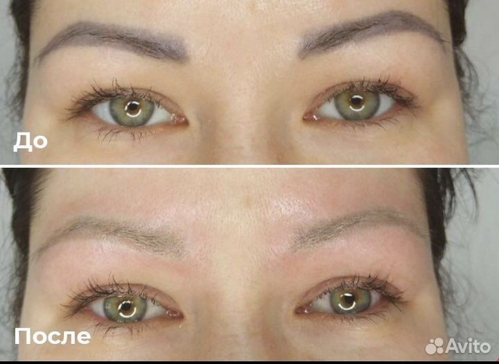 Удаление тату, татуажа, карбоновый пилинг