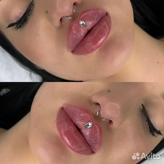 Увеличение губ
