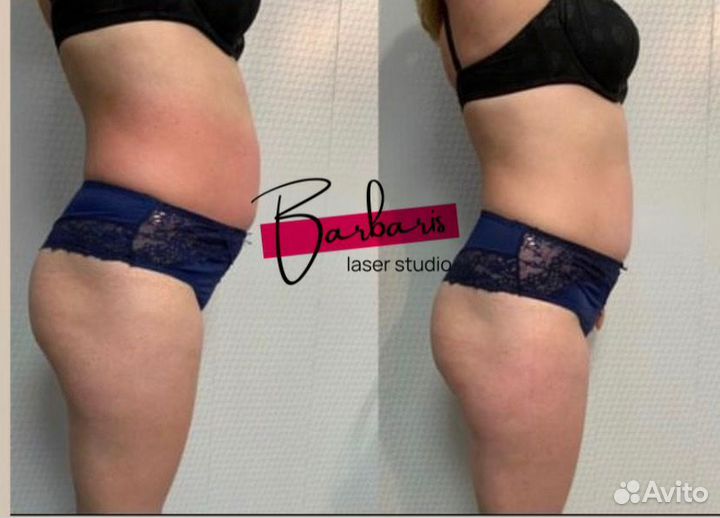 LPG массаж, аппаратный массаж, кавитация