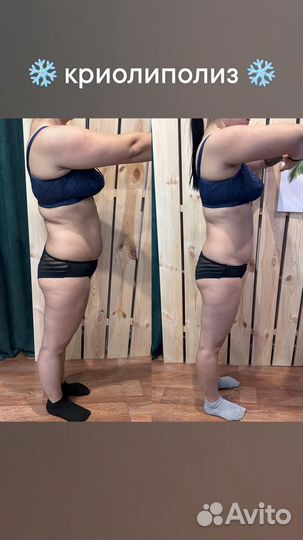 Криолиполиз + миостимуляция