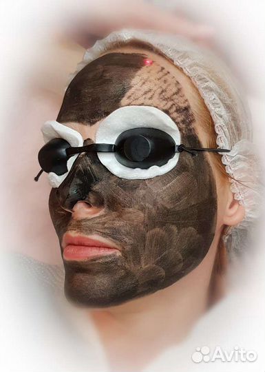 Карбоновый пилинг