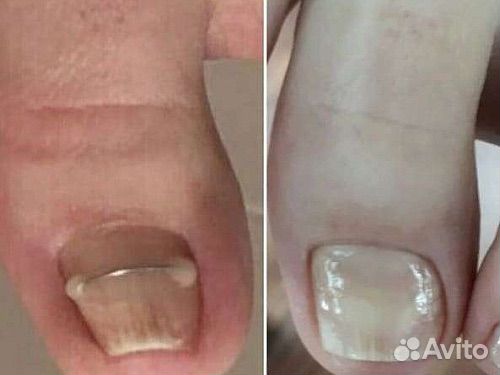 Педикюр медицинский подолог